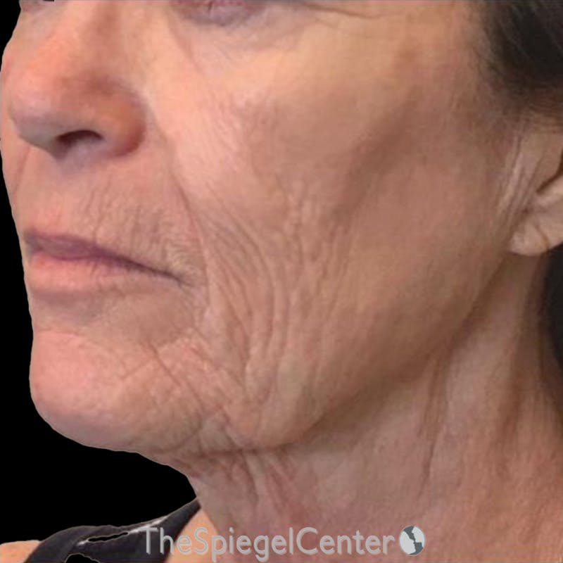 Junera Before & After Gallery - Patient 192361 - Image 2