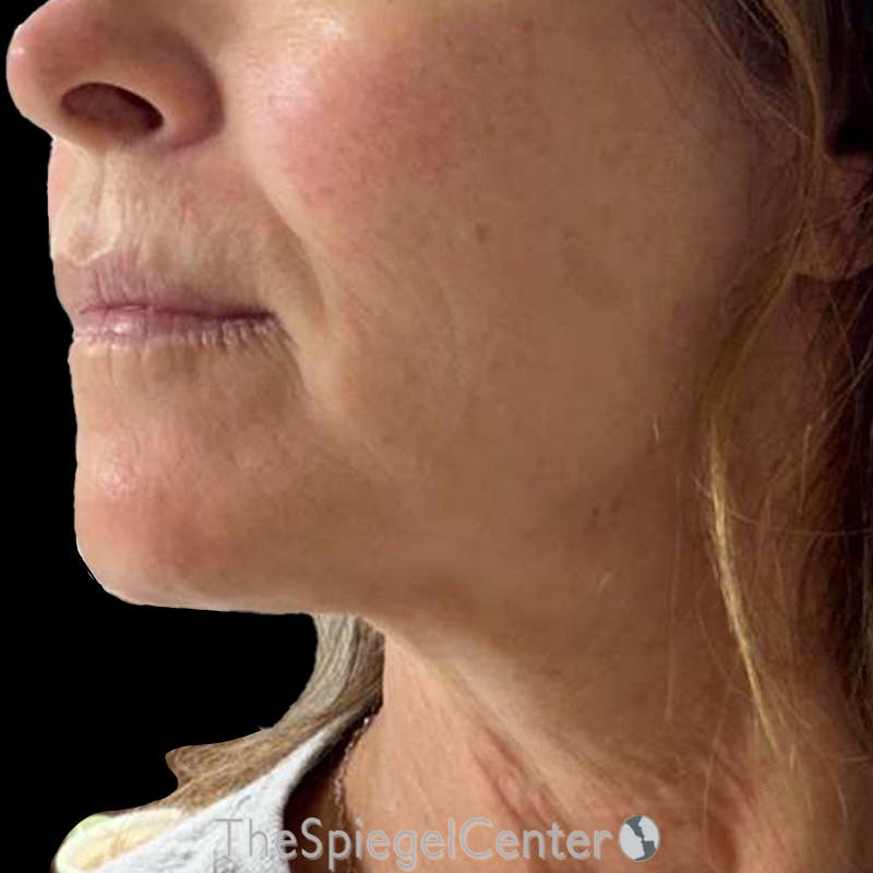 Junera Before & After Gallery - Patient 402189 - Image 2
