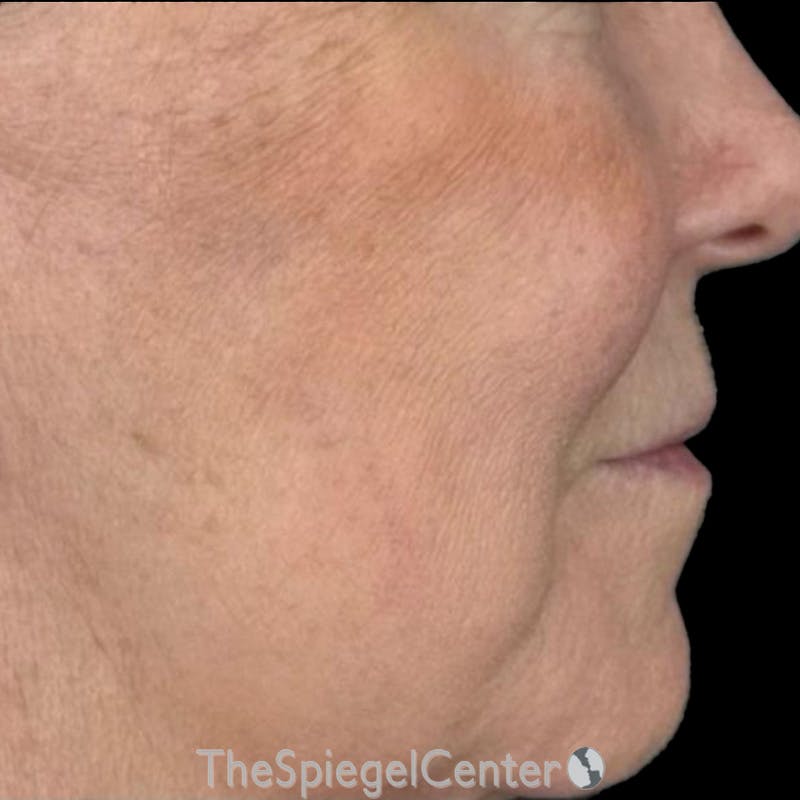 Junera Before & After Gallery - Patient 189961 - Image 2