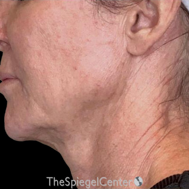 Junera Before & After Gallery - Patient 213576 - Image 1