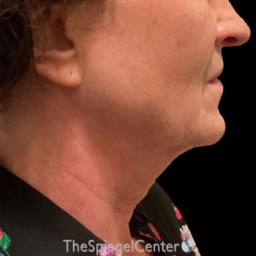 Junera Before & After Gallery - Patient 328734 - Image 1