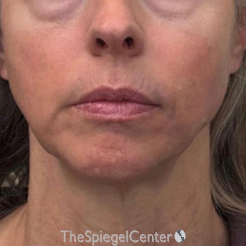 Junera Before & After Gallery - Patient 239418 - Image 1