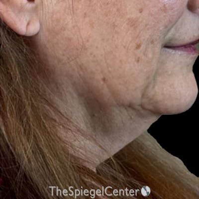 Junera Before & After Gallery - Patient 344086 - Image 1