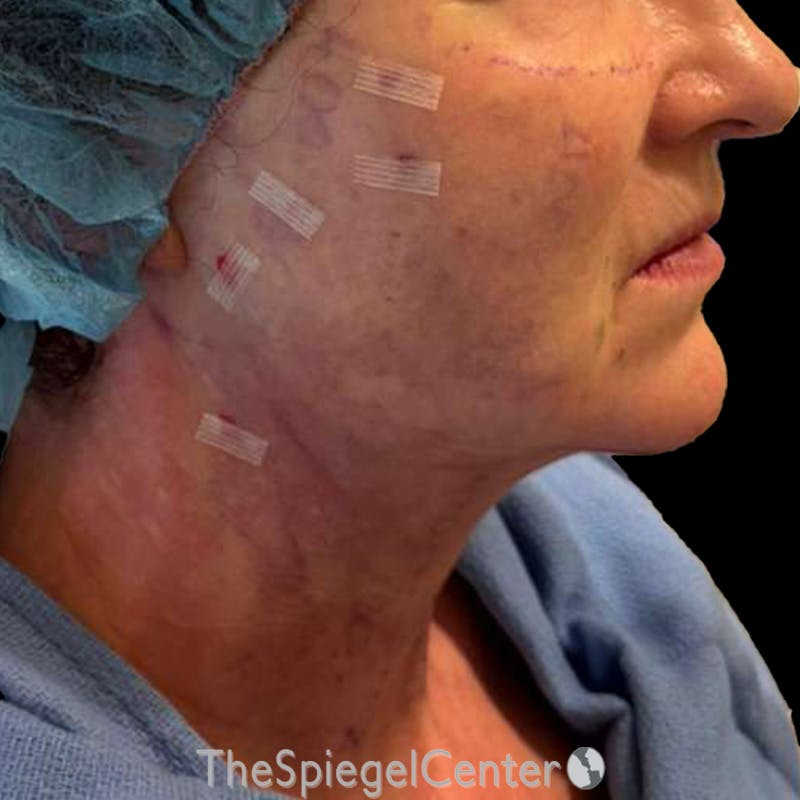 Junera Before & After Gallery - Patient 328734 - Image 2