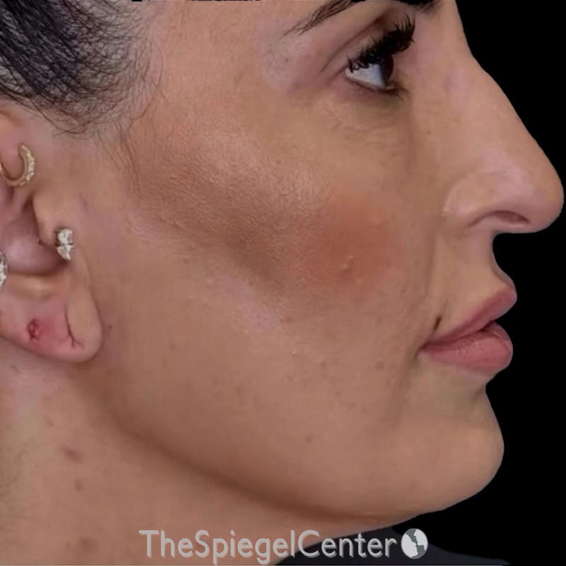 Junera Before & After Gallery - Patient 114346 - Image 2