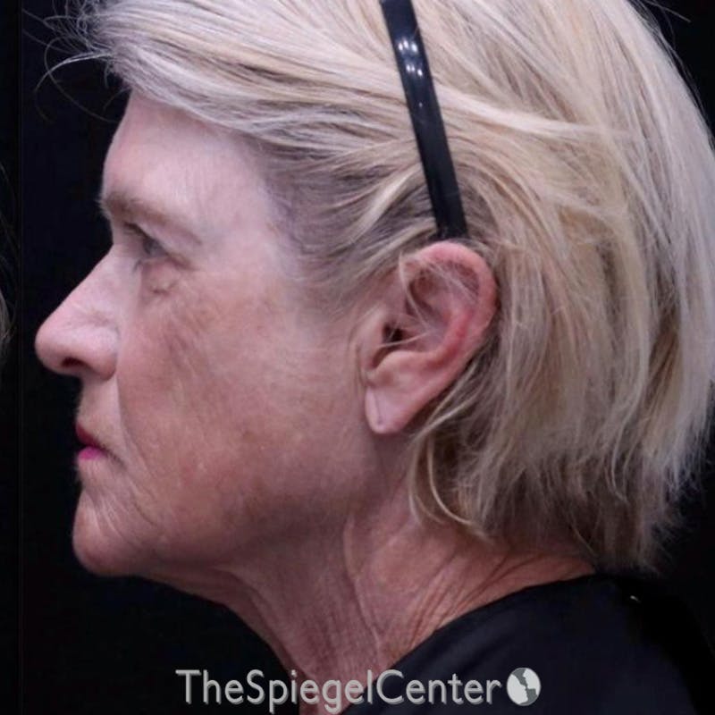 Junera Before & After Gallery - Patient 210006 - Image 2