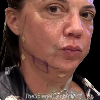 Junera Before & After Gallery - Patient 511811 - Image 4