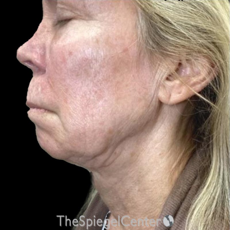 Junera Before & After Gallery - Patient 249726 - Image 1