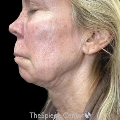 Junera Before & After Gallery - Patient 249726 - Image 1