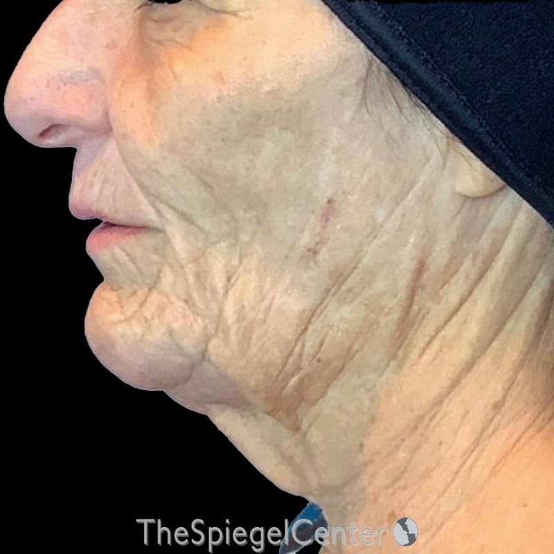 Junera Before & After Gallery - Patient 150424 - Image 1