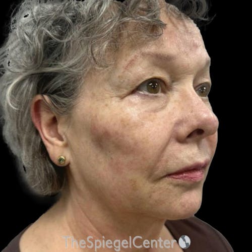 Junera Before & After Gallery - Patient 187506 - Image 2
