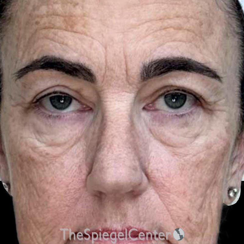 Junera Before & After Gallery - Patient 416137 - Image 1