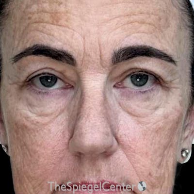 Junera Before & After Gallery - Patient 416137 - Image 1