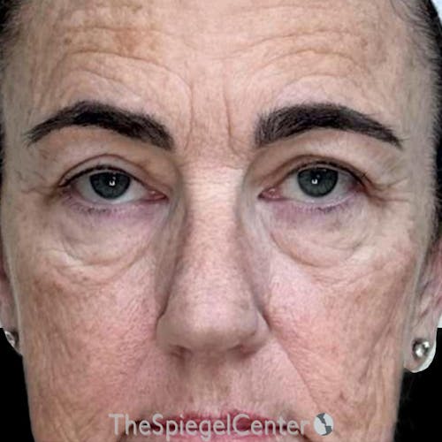 Junera Before & After Gallery - Patient 416137 - Image 1