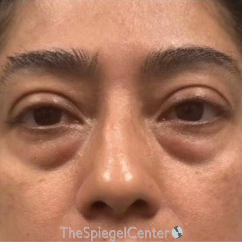 Junera Before & After Gallery - Patient 252979 - Image 1