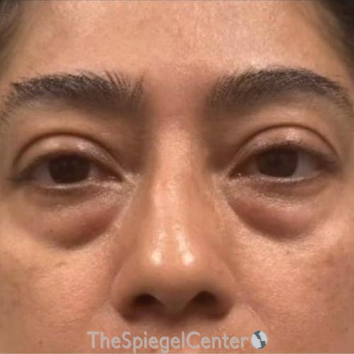 Junera Before & After Gallery - Patient 252979 - Image 1