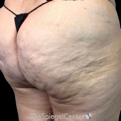 Junera Before & After Gallery - Patient 253095 - Image 1