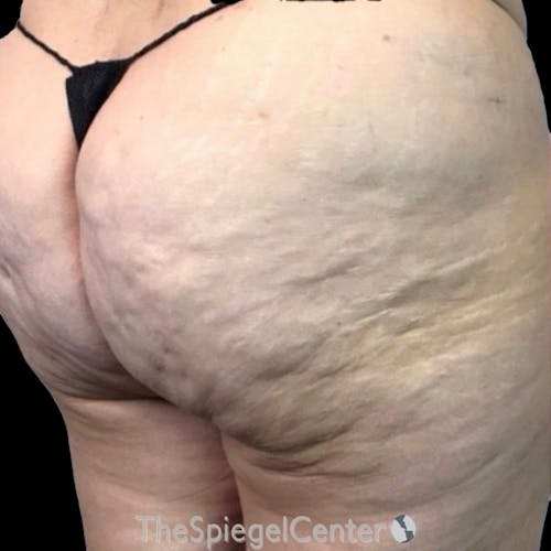 Junera Before & After Gallery - Patient 253095 - Image 1