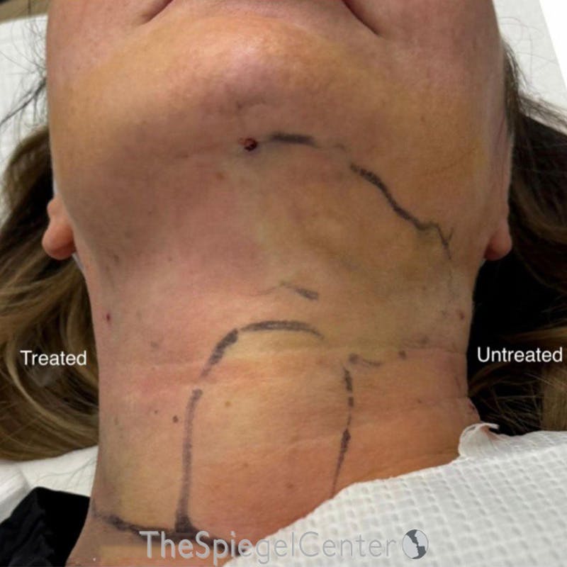 Junera Before & After Gallery - Patient 319628 - Image 2