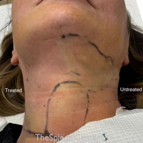 Junera Before & After Gallery - Patient 319628 - Image 2