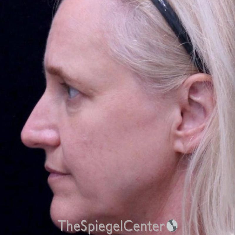 Junera Before & After Gallery - Patient 204764 - Image 1