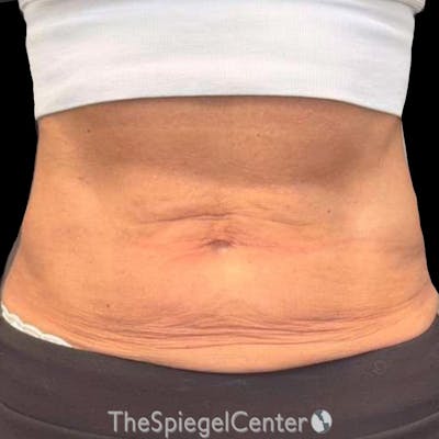 Junera Before & After Gallery - Patient 357320 - Image 1