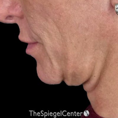 Junera Before & After Gallery - Patient 433316 - Image 1