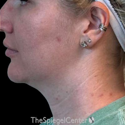 Junera Before & After Gallery - Patient 118641 - Image 1