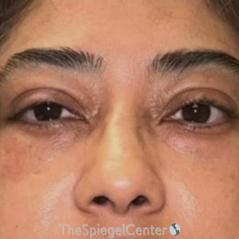 Junera Before & After Gallery - Patient 252979 - Image 2