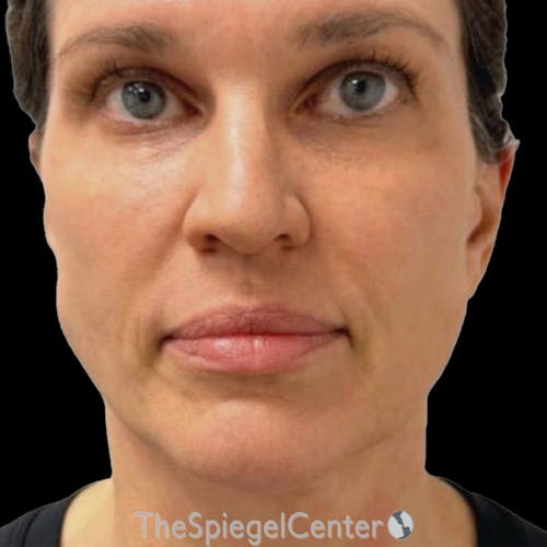 Junera Before & After Gallery - Patient 419181 - Image 2