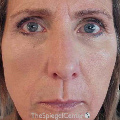Junera Before & After Gallery - Patient 206611 - Image 2