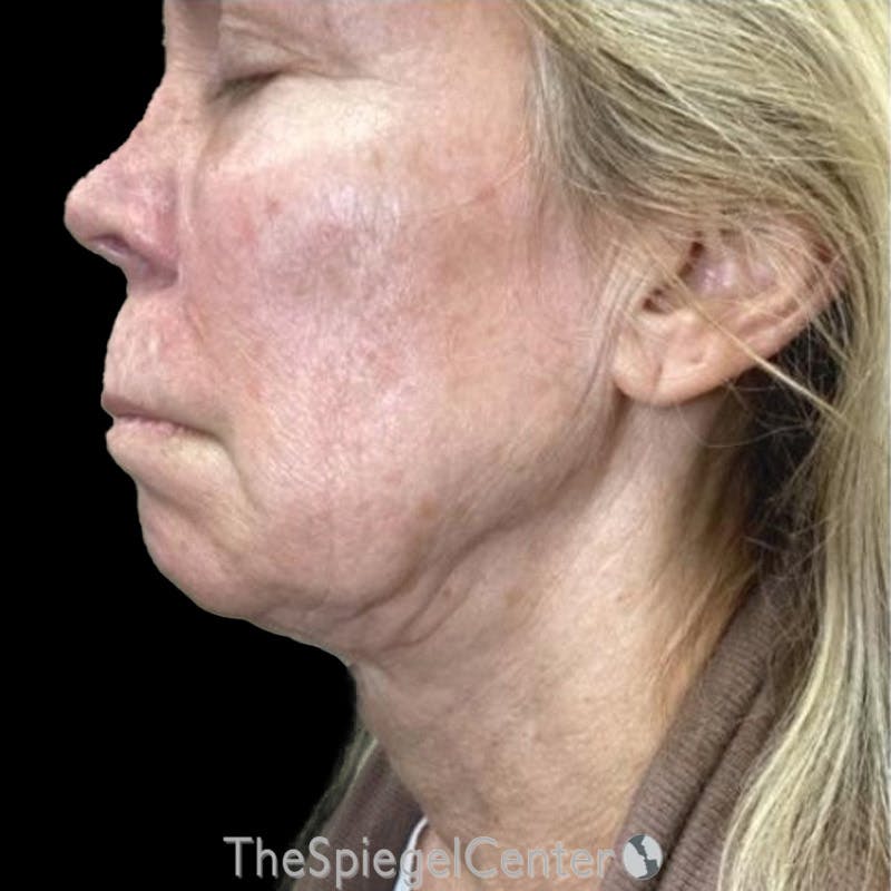 Junera Before & After Gallery - Patient 177514 - Image 1