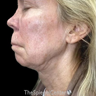 Junera Before & After Gallery - Patient 177514 - Image 1