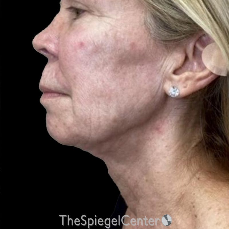 Junera Before & After Gallery - Patient 177514 - Image 2