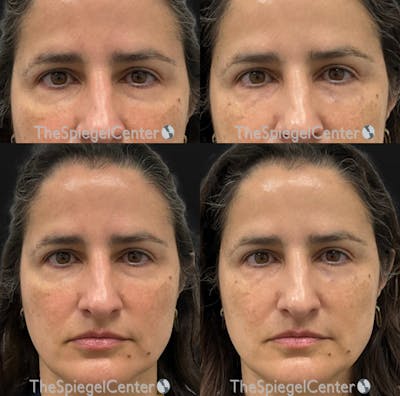 Temple Filler Before & After Gallery - Patient 328736 - Image 1