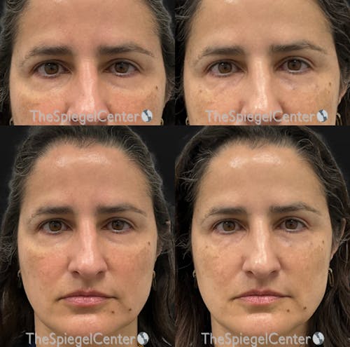 Temple Filler Before & After Gallery - Patient 328736 - Image 1