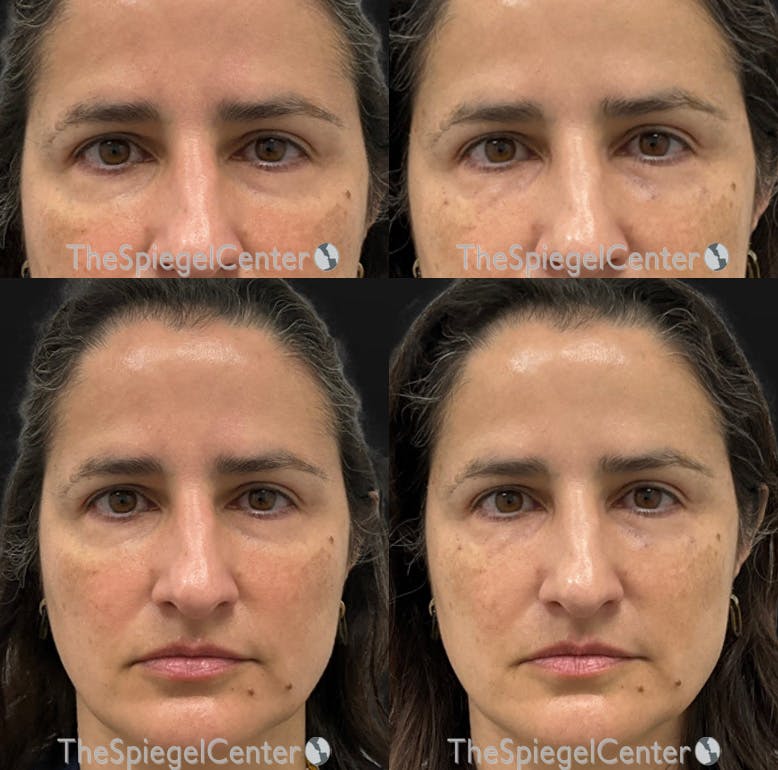 Temple Filler Before & After Gallery - Patient 328736 - Image 1