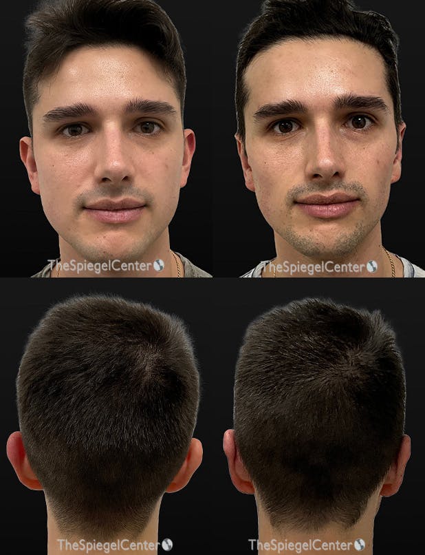 Ear Pinning / Otoplasty Before & After Gallery - Patient 278693 - Image 1