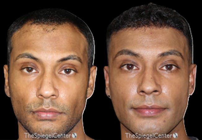 Hair Restoration Before & After Gallery - Patient 360958 - Image 1