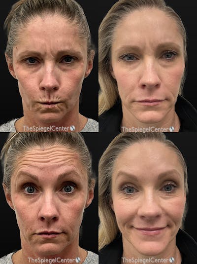 Botox / Dysport / Jeuveau / Xeomin Before & After Gallery - Patient 288437 - Image 1