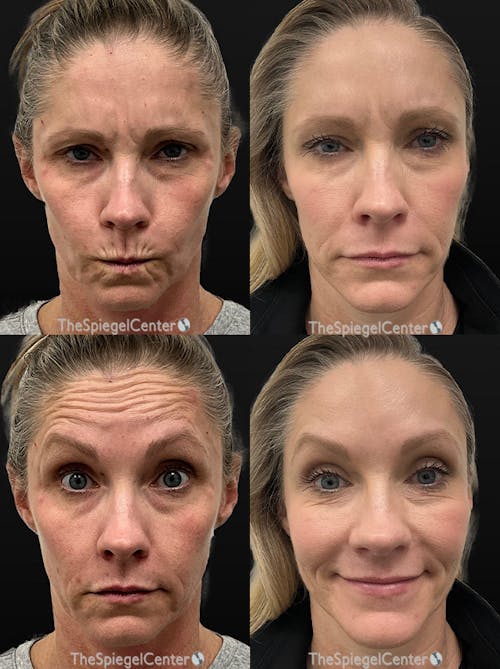 Botox / Dysport / Jeuveau / Xeomin Before & After Gallery - Patient 288437 - Image 1