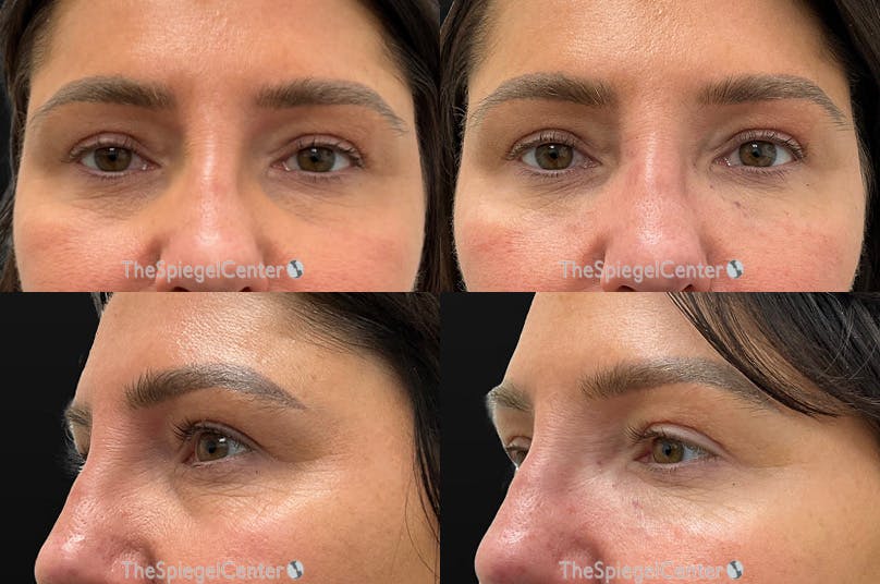 Tear Trough / Under Eye Fillers Before & After Gallery - Patient 390068 - Image 1