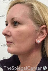 Facelift Before & After Gallery - Patient 649012 - Image 4