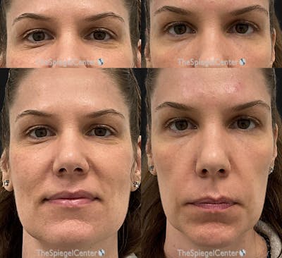 Temple Filler Before & After Gallery - Patient 194069 - Image 1