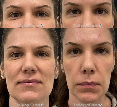 Temple Filler Before & After Gallery - Patient 194069 - Image 1