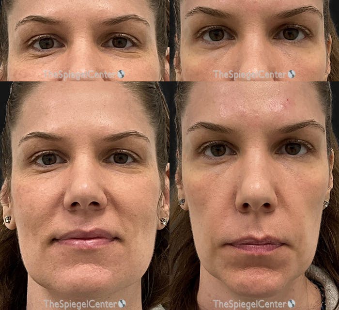 Temple Filler Before & After Gallery - Patient 194069 - Image 1