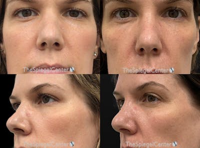 Non-Surgical Rhinoplasty / Nose Filler Before & After Gallery - Patient 268099 - Image 1