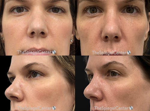 Non-Surgical Rhinoplasty / Nose Filler Before & After Gallery - Patient 268099 - Image 1