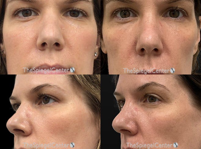 Non-Surgical Rhinoplasty / Nose Filler Before & After Gallery - Patient 268099 - Image 1
