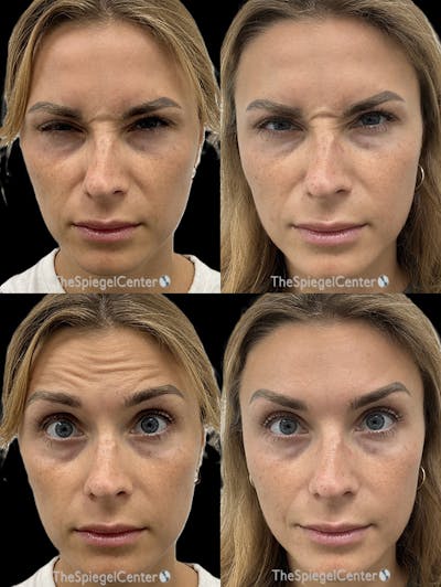 Botox / Dysport / Jeuveau / Xeomin Before & After Gallery - Patient 329810 - Image 1